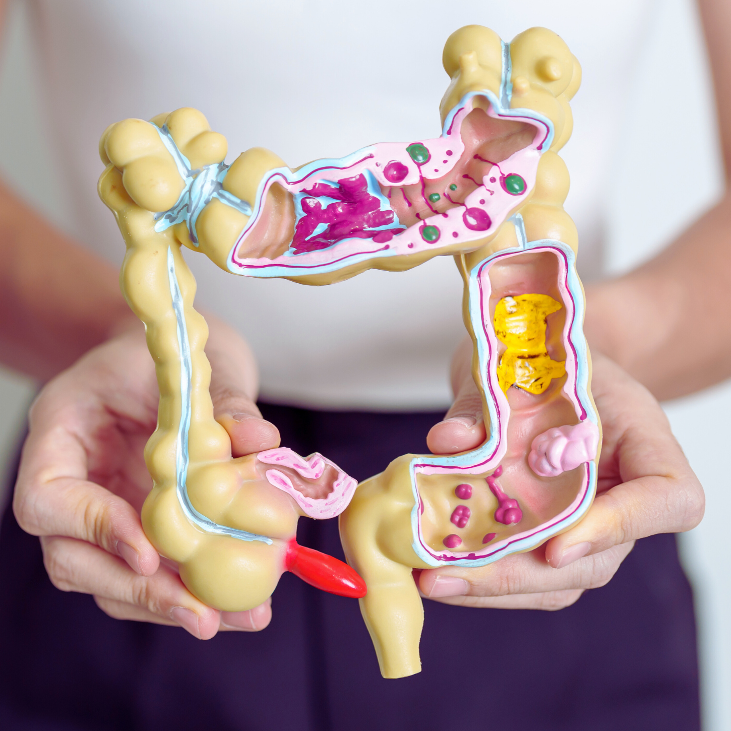 The Hidden Truth About Diverticular Disease (And Why It’s Called The Disease of Civilization)