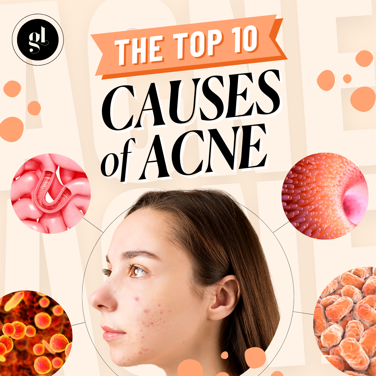 The Top 10 Causes of Acne