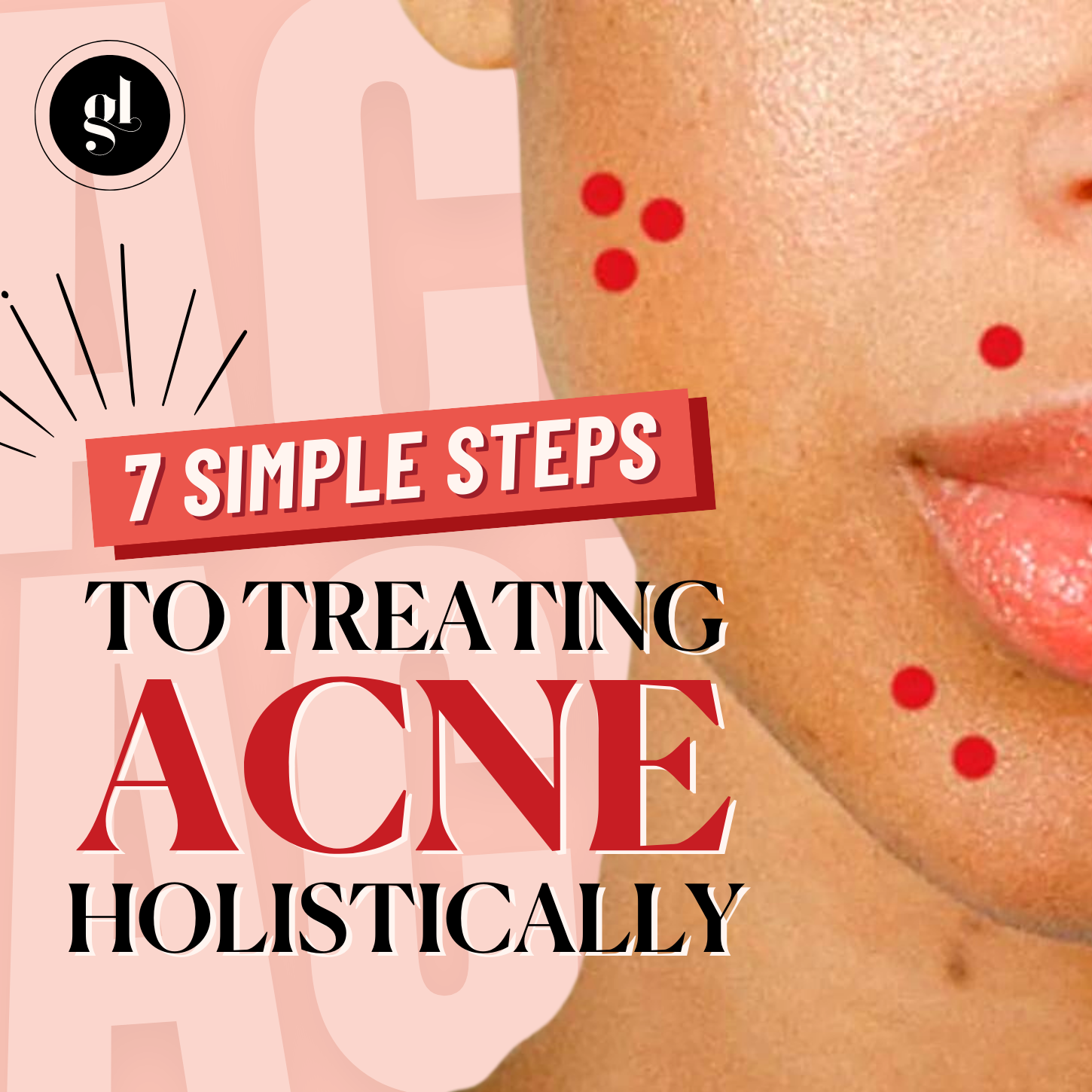7 Simple Steps to Treating Acne Holistically