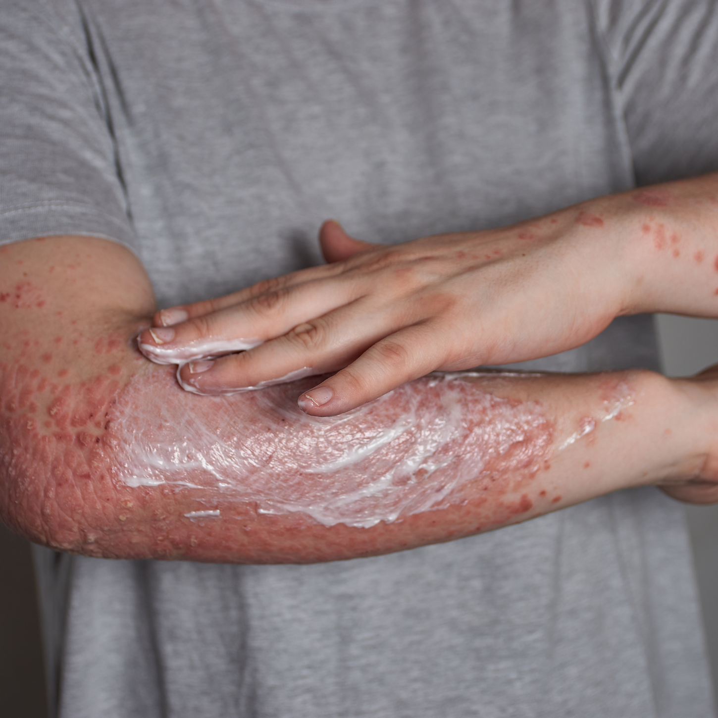 Psoriasis and Your Gut: Healing from the Inside Out (Part 2)